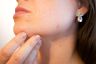 Quels sont nos solutions et conseils pour soigner l'acné juvénile et l'acné hormonal ? 